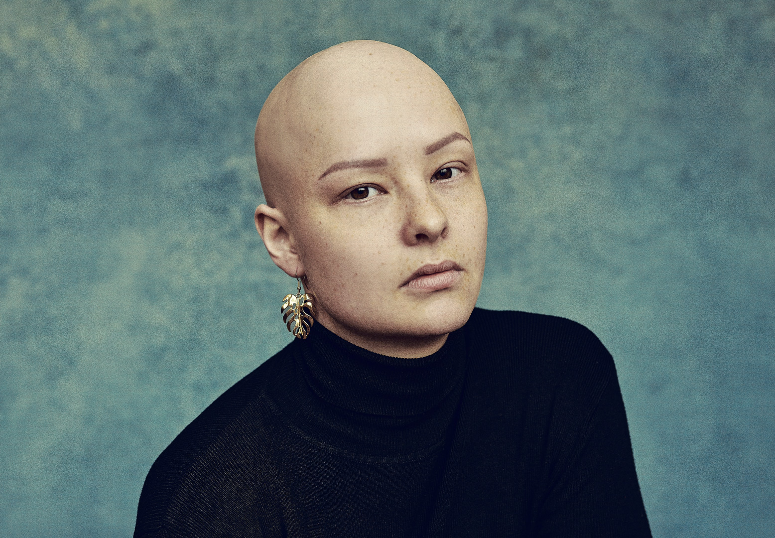 Fee-alopecia-by-Sane-Seven